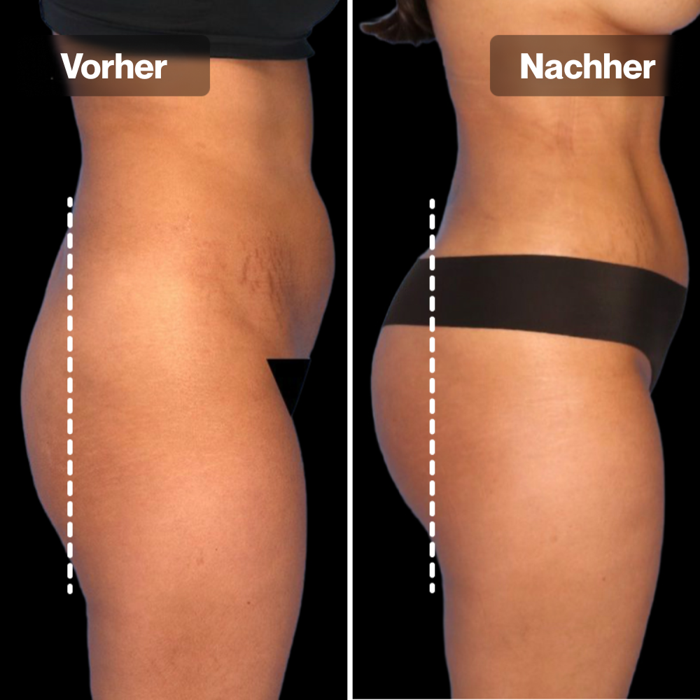 PulseFit Shorts™ - Strafferer Po in 3 Wochen